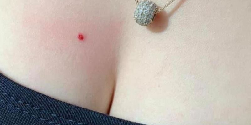 Ý Nghĩa Nốt Ruồi Son – Giải Mã Tài Lộc và Vận Mệnh tại SHBET 5 Ý nghĩa nốt ruồi son